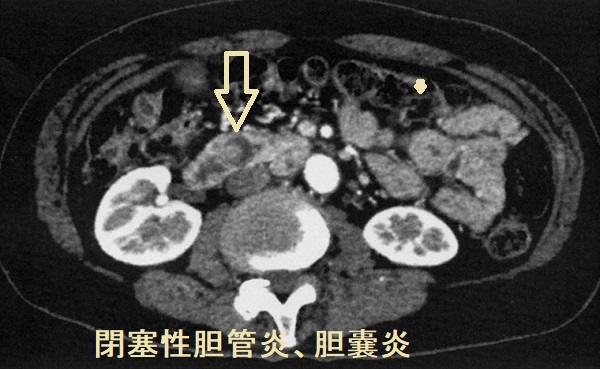 総胆管結石あるいは胆管腫瘍性胆管炎 閉塞性黄疸 CT画像 総胆管結石あるいは胆管腫瘍性胆管炎 閉塞性黄疸 CT画像