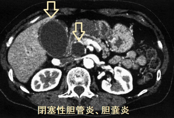 総胆管結石あるいは胆管腫瘍性胆管炎・胆嚢炎 閉塞性黄疸 CT画像 総胆管結石あるいは胆管腫瘍性胆管炎・胆嚢炎 閉塞性黄疸 CT画像