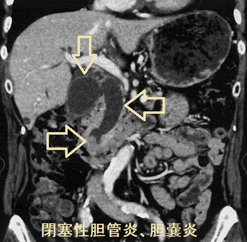 総胆管結石あるいは胆管腫瘍性胆管炎・胆嚢炎 閉塞性黄疸 CT画像 総胆管結石あるいは胆管腫瘍性胆管炎・胆嚢炎 閉塞性黄疸 CT画像