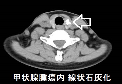 甲状腺腫瘍内 線状石灰化 CT画像 甲状腺腫瘍内 線状石灰化 CT画像