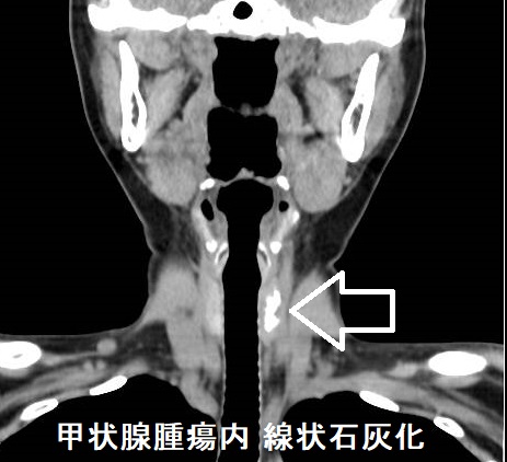 甲状腺腫瘍内 線状石灰化 CT画像 甲状腺腫瘍内 線状石灰化 CT画像