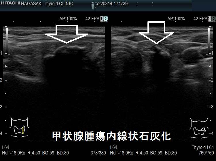 甲状腺腫瘍内 線状石灰化 超音波(エコー)画像 甲状腺腫瘍内 線状石灰化 超音波(エコー)画像