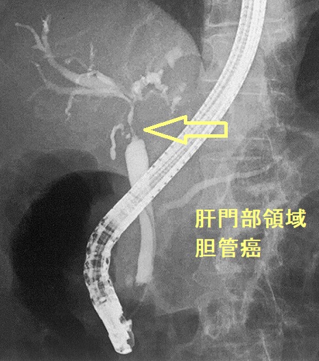 肝門部領域胆管癌 肝門部領域胆管癌