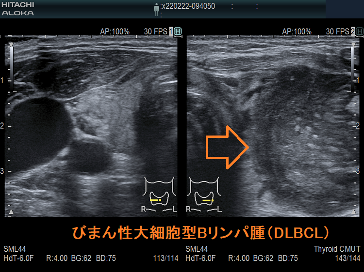 びまん性大細胞型Bリンパ腫(DLBCL) 超音波(エコー)画像 びまん性大細胞型Bリンパ腫(DLBCL) 超音波(エコー)画像
