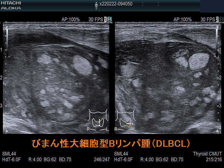 びまん性大細胞型Bリンパ腫(DLBCL) 超音波(エコー)画像 びまん性大細胞型Bリンパ腫(DLBCL) 超音波(エコー)画像
