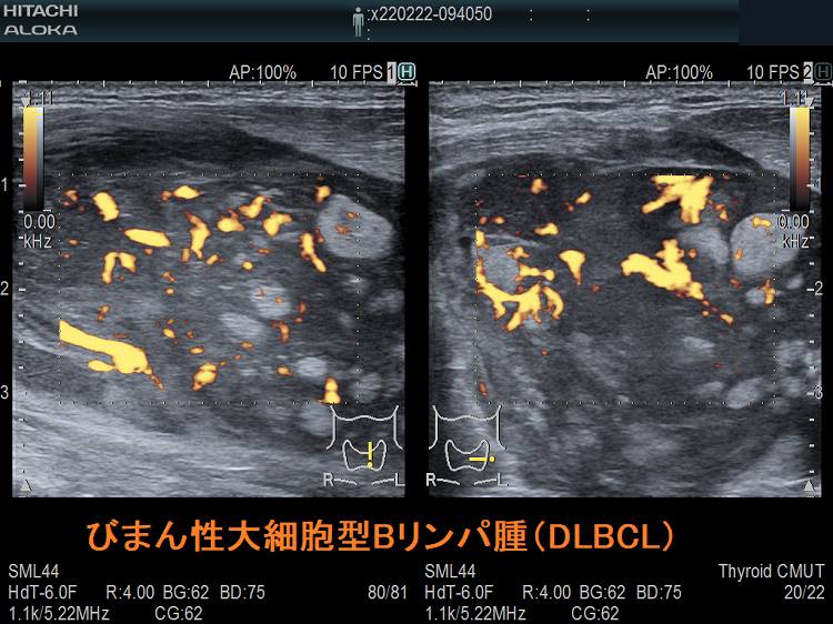 びまん性大細胞型Bリンパ腫(DLBCL) 超音波(エコー)画像 びまん性大細胞型Bリンパ腫(DLBCL)3