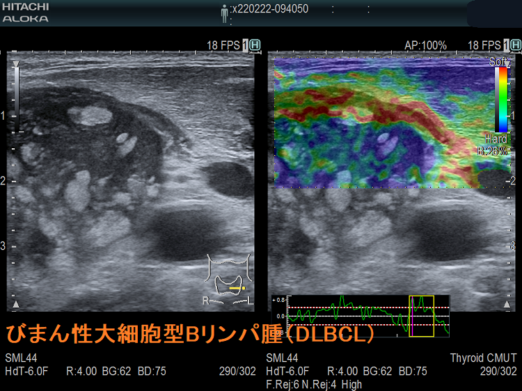 びまん性大細胞型Bリンパ腫(DLBCL) 超音波(エコー)画像 びまん性大細胞型Bリンパ腫(DLBCL)4