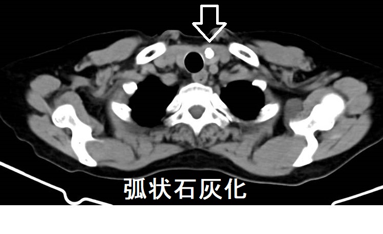 甲状腺内弧状石灰化 CT画像 甲状腺内弧状石灰化 CT画像