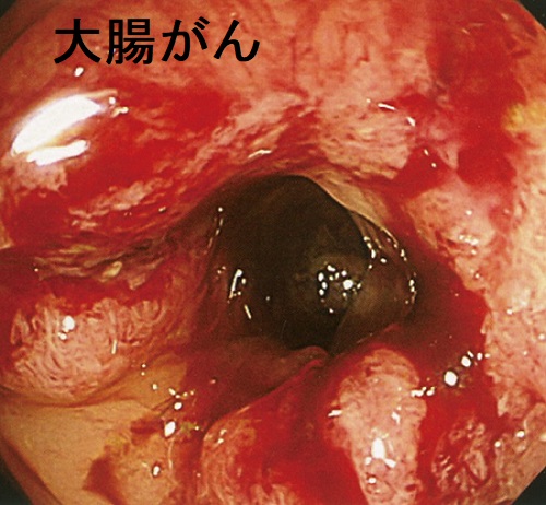 大腸がん 大腸がん