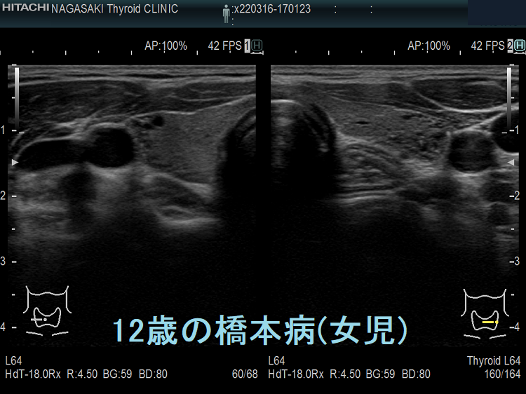 12歳の橋本病 超音波(エコー)画像 12歳の橋本病 超音波(エコー)画像