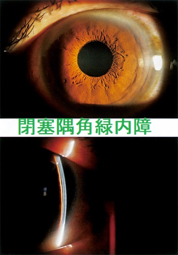 閉塞隅角緑内障 閉塞隅角緑内障
