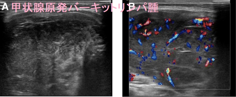 甲状腺原発バーキットリンパ腫 甲状腺原発バーキットリンパ腫