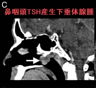 TSH産生下垂体神経内分泌腫瘍(原因,症状,甲状腺癌,治療),TSH不 TSH産生下垂体神経内分泌腫瘍(原因,症状,甲状腺癌,治療),TSH不