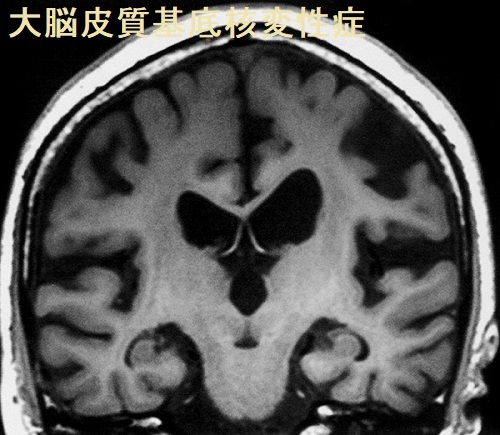 大脳皮質基底核変性症 MRI T1 強調画像 大脳皮質基底核変性症 MRI T1 強調画像