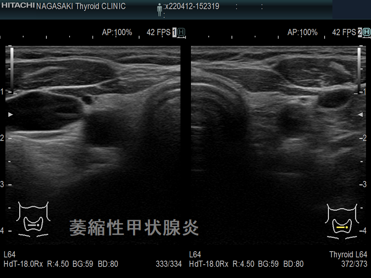 萎縮性甲状腺炎 超音波(エコー)画像 萎縮性甲状腺炎 超音波(エコー)画像