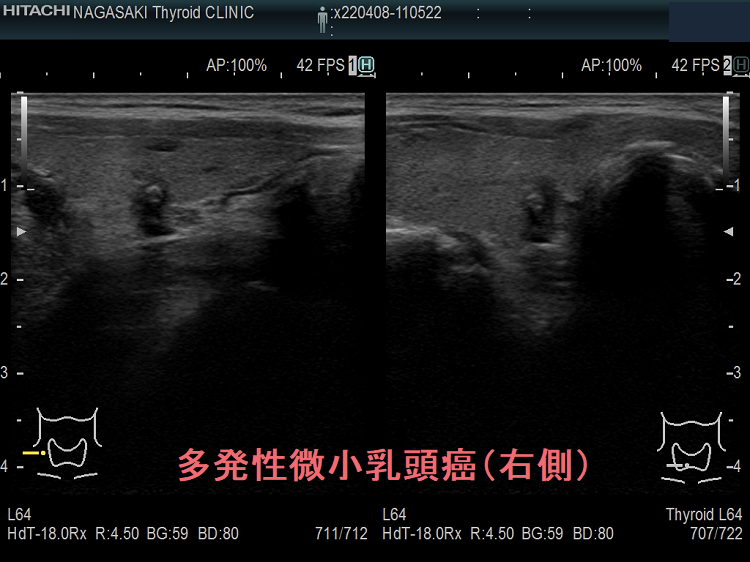 多発性微小乳頭癌(右側) 多発性微小乳頭癌(右側)