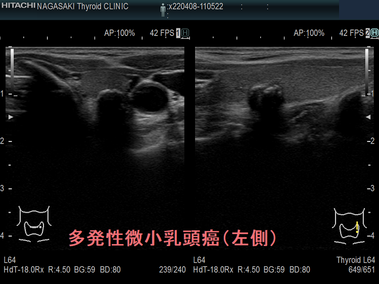 多発性微小乳頭癌(左側) 多発性微小乳頭癌(左側)