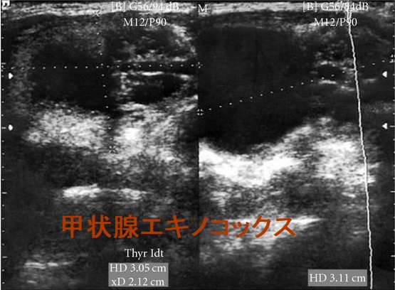 甲状腺エキノコックス症 甲状腺エキノコックス症