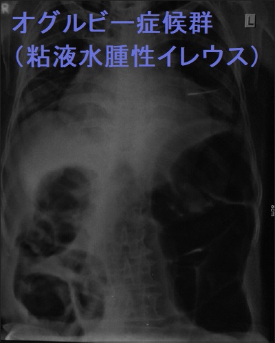 オグルビー症候群(粘液水腫性イレウス) オグルビー症候群(粘液水腫性イレウス)