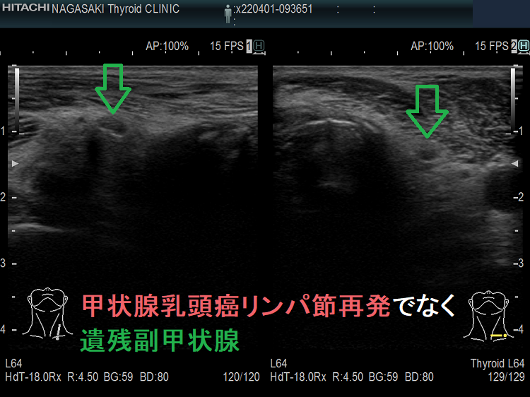 甲状腺乳頭癌リンパ節再発でなく遺残副甲状腺 超音波(エコー)画像 甲状腺乳頭癌リンパ節再発でなく遺残副甲状腺 超音波(エコー)画像