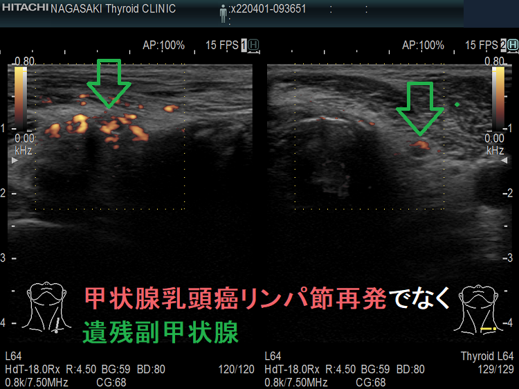 甲状腺乳頭癌リンパ節再発でなく遺残副甲状腺 超音波(エコー)画像 ドプラーモード 甲状腺乳頭癌リンパ節再発でなく遺残副甲状腺 超音波(エコー)画像 ドプラーモード