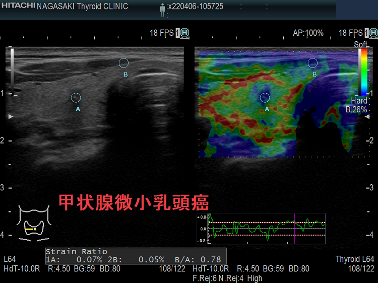 典型的な甲状腺微小乳頭癌 エラストグラフィー 典型的な甲状腺微小乳頭癌 エラストグラフィー