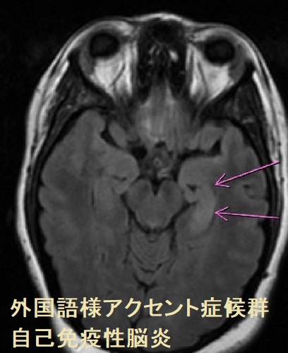 外国語様アクセント症候群 自己免疫性脳炎 外国語様アクセント症候群 自己免疫性脳炎