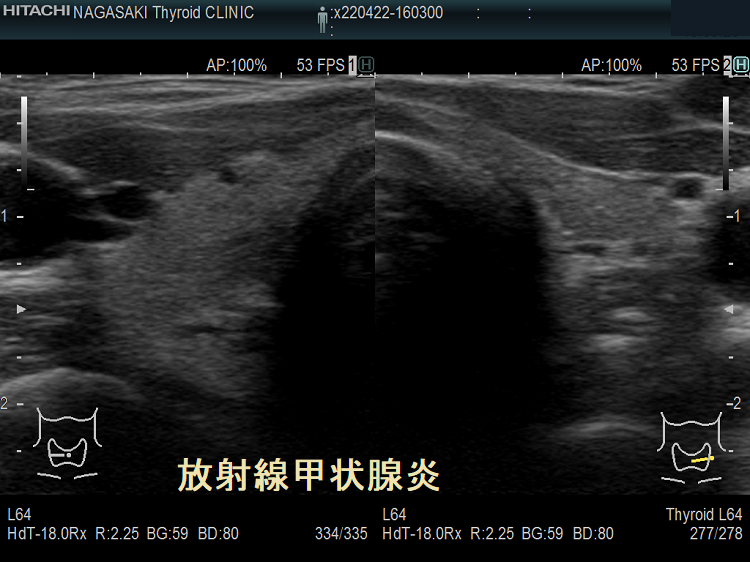 放射線甲状腺炎 超音波(エコー)画像 (拡大); 放射線甲状腺炎 超音波(エコー)画像 (拡大);