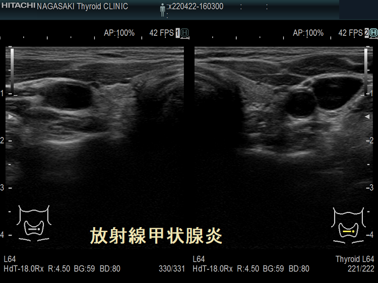 萎縮が進んだ放射線甲状腺炎 超音波(エコー)画像 萎縮が進んだ放射線甲状腺炎 超音波(エコー)画像