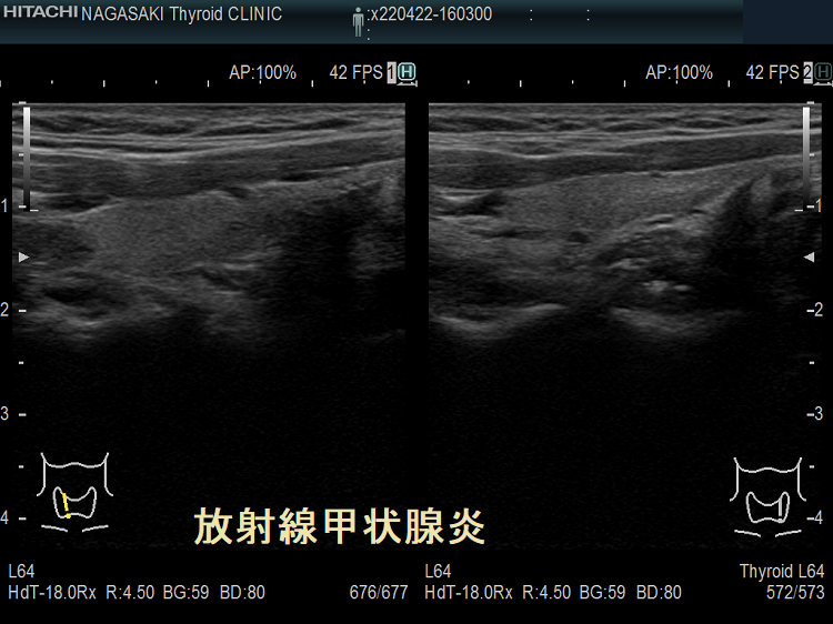 萎縮が進んだ放射線甲状腺炎 超音波(エコー)画像 萎縮が進んだ放射線甲状腺炎 超音波(エコー)画像