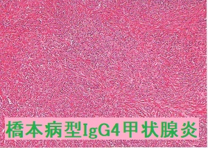 橋本病型IgG4甲状腺炎 組織像 弱拡大 橋本病型IgG4甲状腺炎 組織像 弱拡大