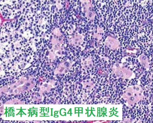 橋本病型IgG4甲状腺炎 組織像(強拡大) 橋本病型IgG4甲状腺炎 組織像(強拡大)