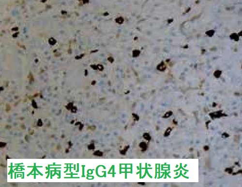 橋本病型IgG4甲状腺炎 IgG4免疫染色 橋本病型IgG4甲状腺炎 IgG4免疫染色