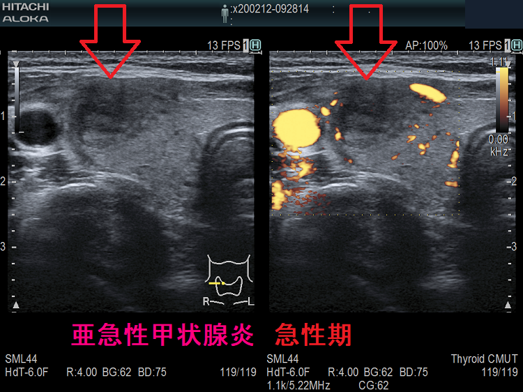 亜急性甲状腺炎 急性期 超音波(エコー)画像 亜急性甲状腺炎 急性期 超音波(エコー)画像