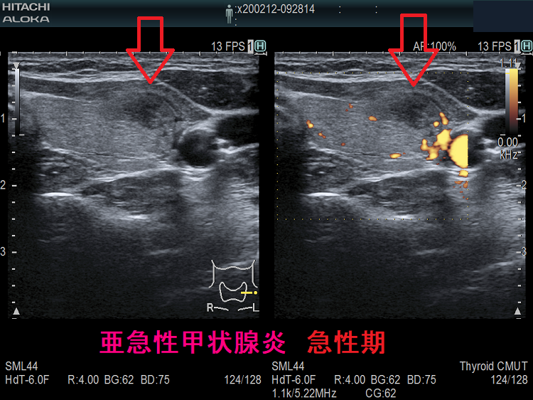 亜急性甲状腺炎 急性期 超音波(エコー)画像 亜急性甲状腺炎 急性期 超音波(エコー)画像
