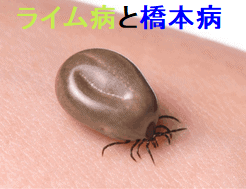 ライム病と橋本病 ライム病と橋本病