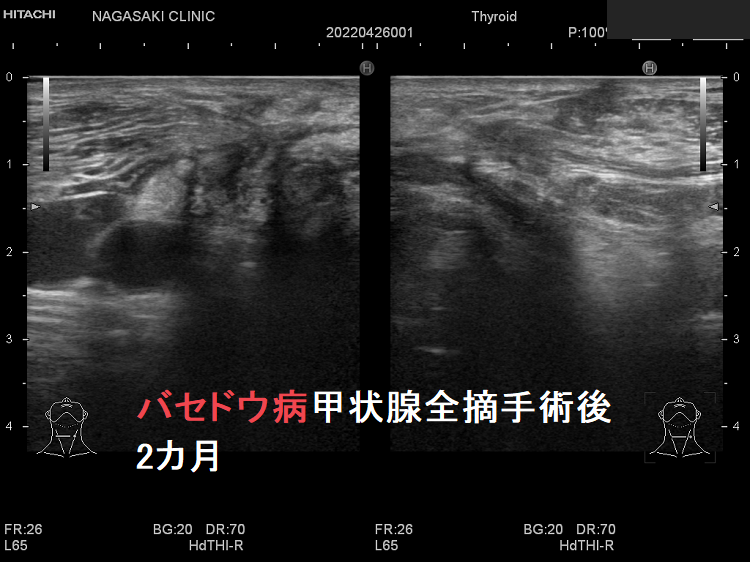 バセドウ病甲状腺全摘出後 2カ月 超音波(エコー)画像 バセドウ病甲状腺全摘出後 2カ月 超音波(エコー)画像
