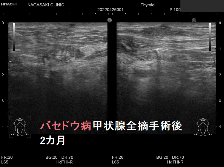 バセドウ病甲状腺全摘出後 2カ月 超音波(エコー)画像 バセドウ病甲状腺全摘出後 2カ月 超音波(エコー)画像