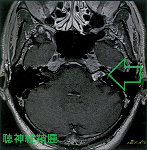 聴神経鞘腫 造影MRI T1画像 聴神経鞘腫 造影MRI T1画像