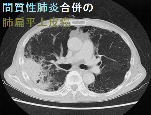 間質性肺炎に肺扁平上皮癌を合併 胸部X線 間質性肺炎に肺扁平上皮癌を合併 胸部X線