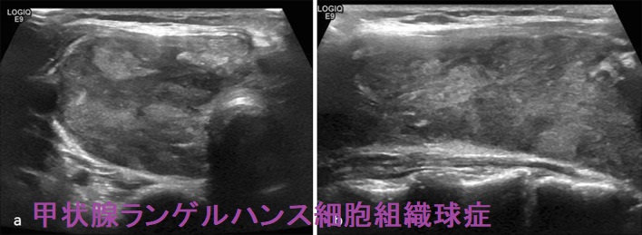甲状腺ランゲルハンス細胞組織球症 超音波(エコー)画像 甲状腺ランゲルハンス細胞組織球症 超音波(エコー)画像