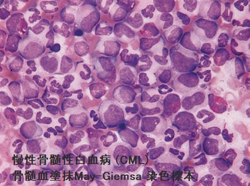 慢性骨髄性白血病(CML) 骨髄血塗抹May-Giemsa 染色標本 慢性骨髄性白血病(CML) 骨髄血塗抹May-Giemsa 染色標本