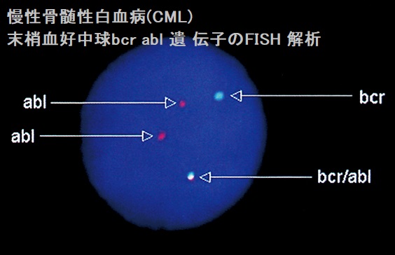 慢性骨髄性白血病(CML) 末梢血好中球bcr abl 遺伝子のFISH 解析 慢性骨髄性白血病(CML) 末梢血好中球bcr abl 遺伝子のFISH 解析