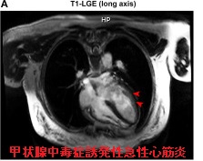 甲状腺中毒症誘発性急性心筋炎 甲状腺中毒症誘発性急性心筋炎