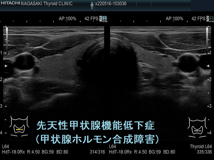 遺伝性・先天性甲状腺ホルモン合成障害 超音波(エコー)画像 遺伝性・先天性甲状腺ホルモン合成障害 超音波(エコー)画像