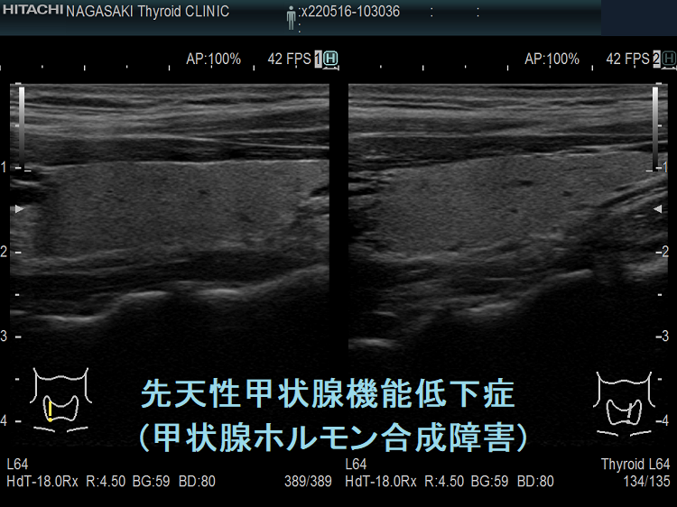 遺伝性・先天性甲状腺ホルモン合成障害 超音波(エコー)画像 遺伝性・先天性甲状腺ホルモン合成障害 超音波(エコー)画像