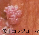 尖圭コンジローマ 尖圭コンジローマ