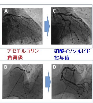 甲状腺機能亢進症 バセドウ病に伴う冠攣縮性狭心症による心室細動(Vf) アセチルコリン負荷試験 甲状腺機能亢進症 バセドウ病に伴う冠攣縮性狭心症による心室細動(Vf) アセチルコリン負荷試験