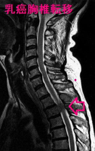 乳癌胸椎転移 頸胸椎MRI T2 強調矢状断像 乳癌胸椎転移 頸胸椎MRI T2 強調矢状断像
