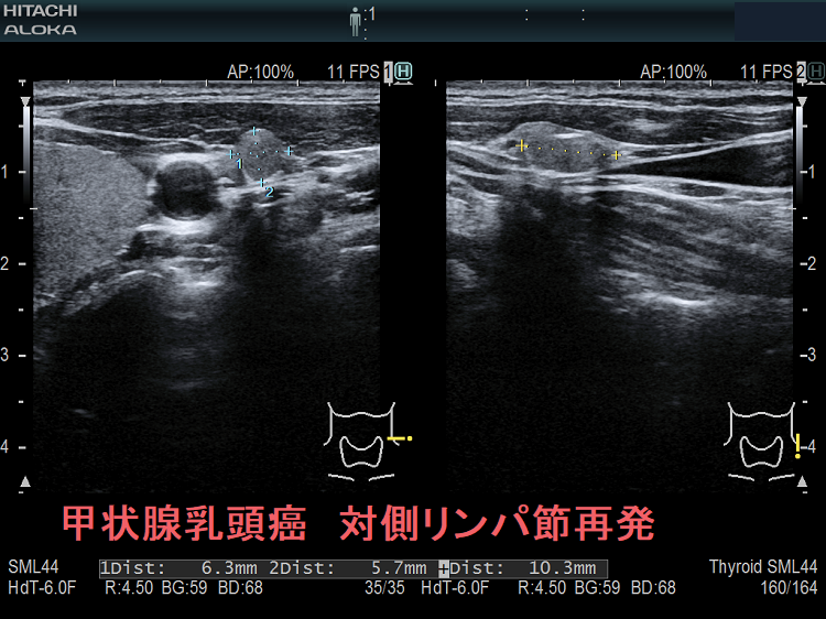 甲状腺乳頭癌 対側(切除していない側)リンパ節再発 超音波(エコー)画像 甲状腺乳頭癌 対側(切除していない側)リンパ節再発 超音波(エコー)画像